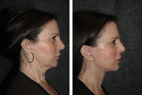 Andrew Jacono, MD neck lift result — New York, NY