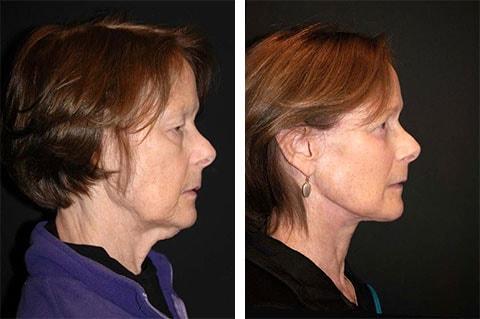 Andrew Jacono, MD neck lift result — New York, NY