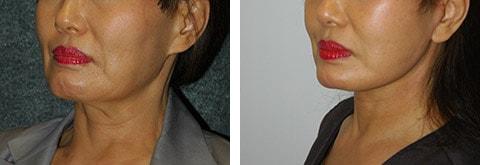 Andrew Jacono, MD facelift result — New York, NY