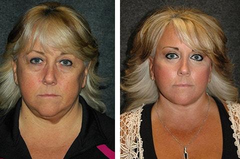Andrew Jacono, MD facelift result — New York, NY