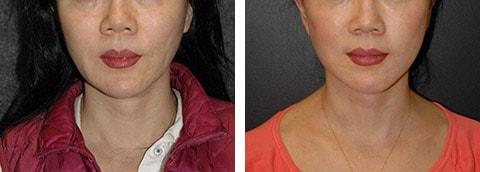Andrew Jacono, MD facelift result — New York, NY