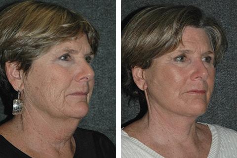Andrew Jacono, MD neck lift result — New York, NY