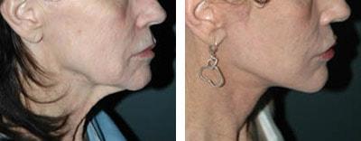 Andrew Jacono, MD neck lift result — New York, NY