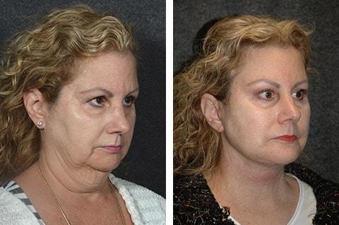 Andrew Jacono, MD neck lift result — New York, NY