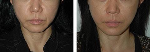 Andrew Jacono, MD facelift result — New York, NY