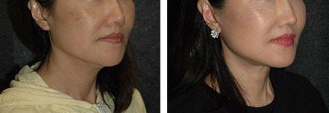 Andrew Jacono, MD facelift result — New York, NY