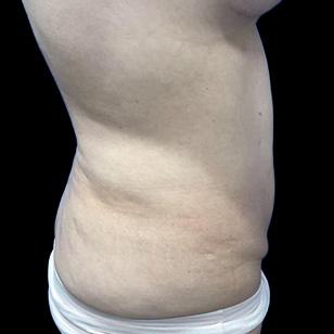 Revalla Plastic Surgery tummy tuck after — Littleton, CO
