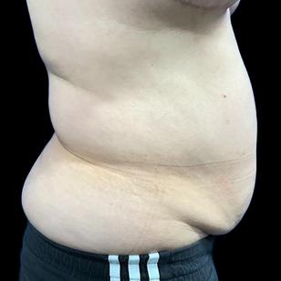 Tummy Tuck before at Revalla Plastic Surgery in Littleton, CO