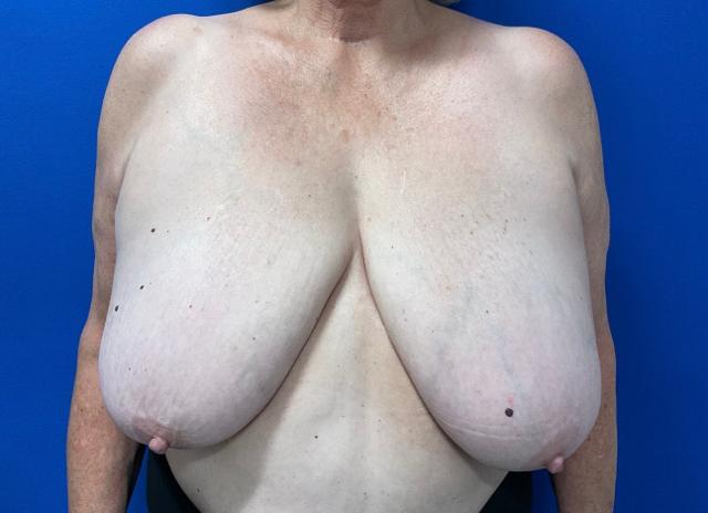 Breast Reduction before at Revalla Plastic Surgery in Littleton, CO