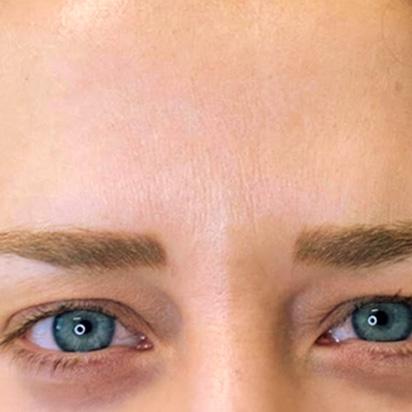 Brow Lift after at Spa Trouve in Orem, UT