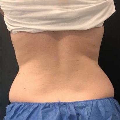 CoolSculpting after at Spa Trouve in Orem, UT