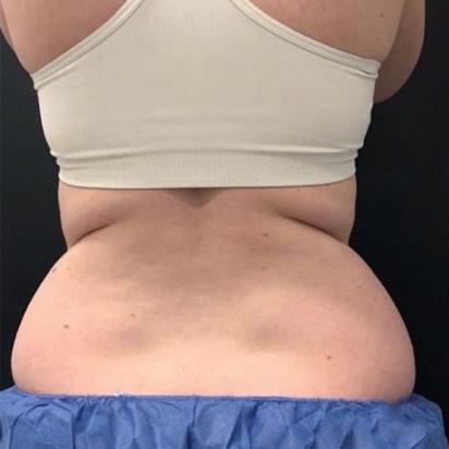 CoolSculpting before at Spa Trouve in Orem, UT