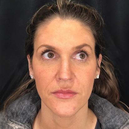Brow Lift after at Spa Trouve in Orem, UT
