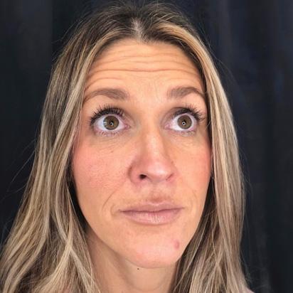 Brow Lift before at Spa Trouve in Orem, UT