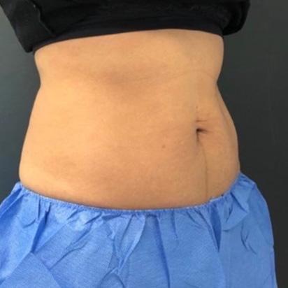 Spa Trouve coolsculpting after — Orem, UT