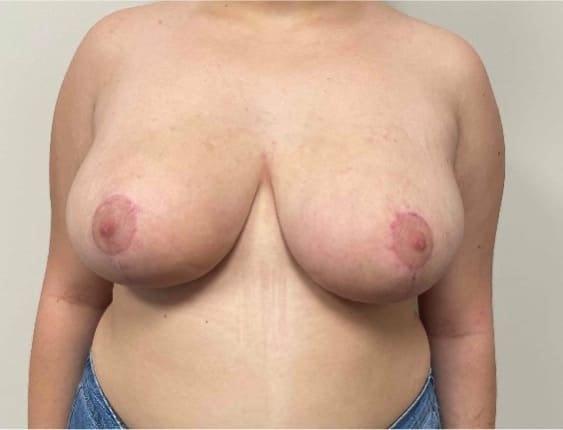 South Florida Aesthetic and Reconstructive Surgery breast reduction after — Hollywood, FL