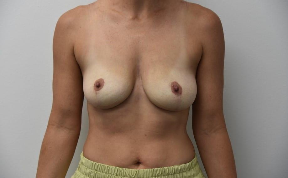 South Florida Aesthetic and Reconstructive Surgery breast lift after — Hollywood, FL