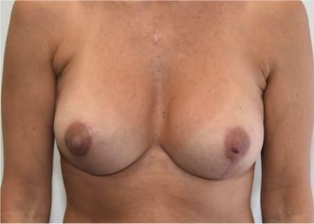 South Florida Aesthetic and Reconstructive Surgery breast augmentation revision after — Hollywood, FL