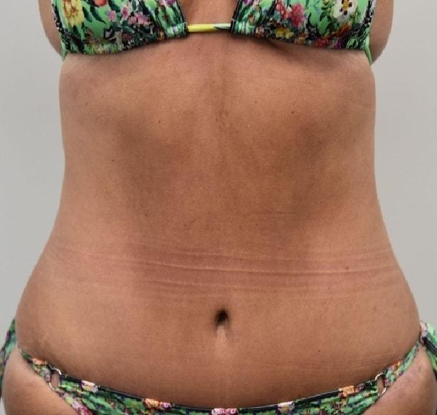 South Florida Aesthetic and Reconstructive Surgery tummy tuck after — Hollywood, FL