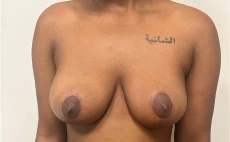 South Florida Aesthetic and Reconstructive Surgery breast reduction after — Hollywood, FL