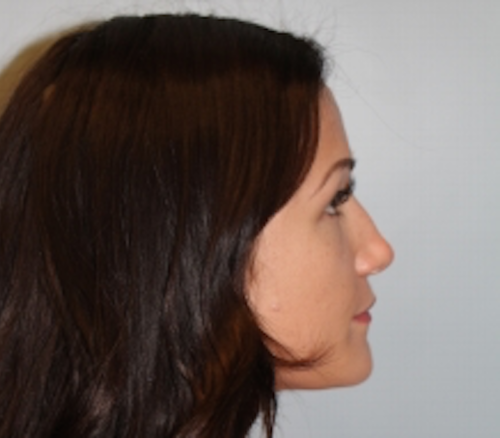 Rhinoplasty before at Richards Cosmetic Surgery in Las Vegas, NV