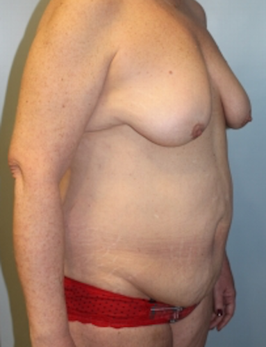Mommy Makeover before at Richards Cosmetic Surgery in Las Vegas, NV