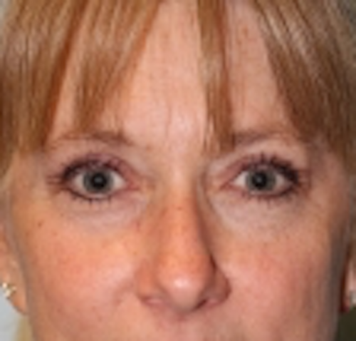 Blepharoplasty after at Richards Cosmetic Surgery in Las Vegas, NV