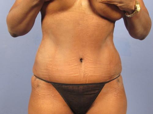 Tummy Tuck after at Richards Cosmetic Surgery in Las Vegas, NV