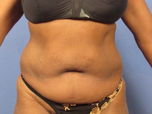 Tummy Tuck before at Richards Cosmetic Surgery in Las Vegas, NV