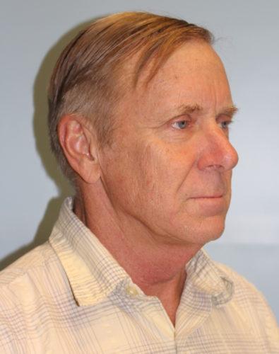 Facelift before at Richards Cosmetic Surgery in Las Vegas, NV