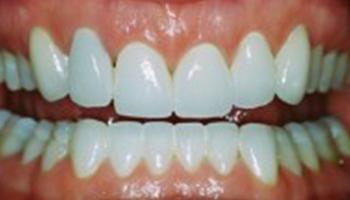 Caring Family Dentistry Irvine smile makeover after — Irvine, CA