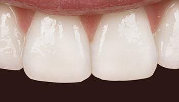 Smile Makeover after at Caring Family Dentistry Irvine in Irvine, CA