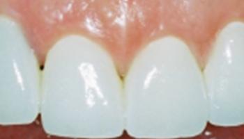 Smile Makeover after at Caring Family Dentistry Irvine in Irvine, CA