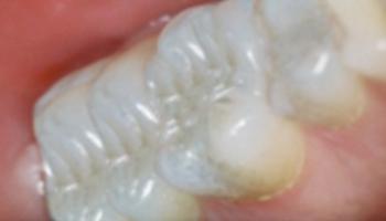 Caring Family Dentistry Irvine smile makeover after — Irvine, CA