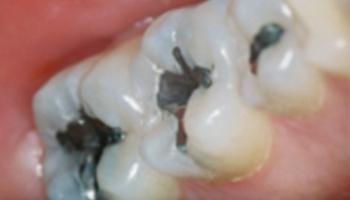Smile Makeover before at Caring Family Dentistry Irvine in Irvine, CA