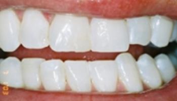 Caring Family Dentistry Irvine smile makeover after — Irvine, CA