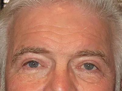Ophthalmic Plastic Surgeons of Texas brow lift after — Houston, TX