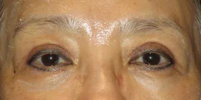 Ophthalmic Plastic Surgeons of Texas eyelid lift after — Houston, TX