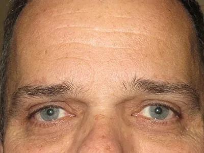 Ophthalmic Plastic Surgeons of Texas brow lift after — Houston, TX