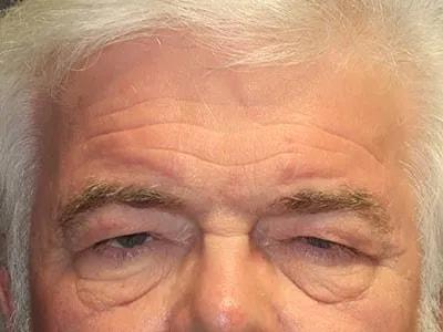 Brow Lift before at Ophthalmic Plastic Surgeons of Texas in Houston, TX