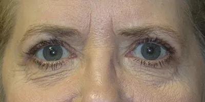 Ophthalmic Plastic Surgeons of Texas eyelid lift after — Houston, TX