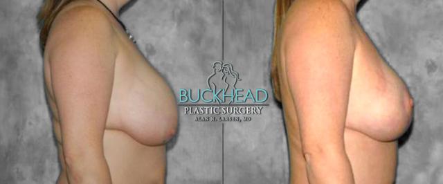 Breast Lift result at Buckhead Plastic Surgery (Alan N. Larsen MD) in Atlanta, GA