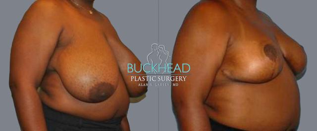 Breast Reduction result at Buckhead Plastic Surgery (Alan N. Larsen MD) in Atlanta, GA
