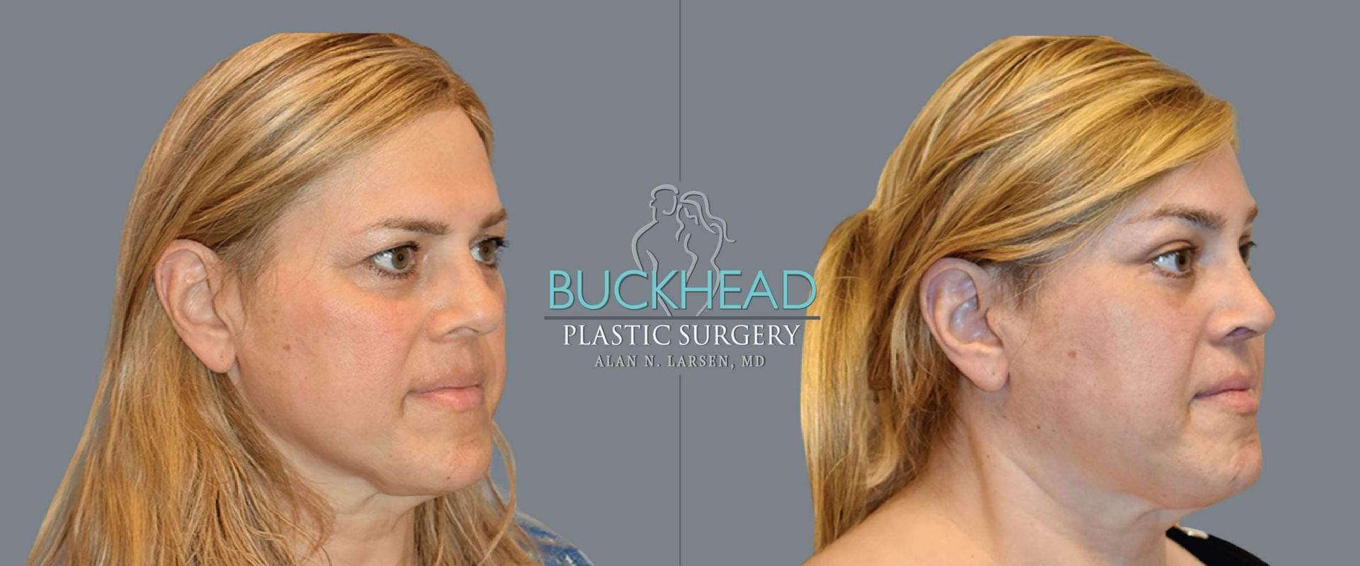 Buckhead Plastic Surgery (Alan N. Larsen MD) brow lift result — Atlanta, GA