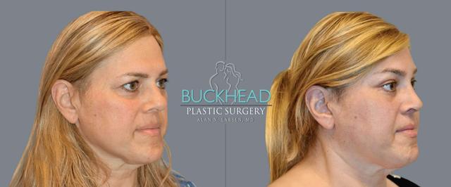 Brow Lift result at Buckhead Plastic Surgery (Alan N. Larsen MD) in Atlanta, GA