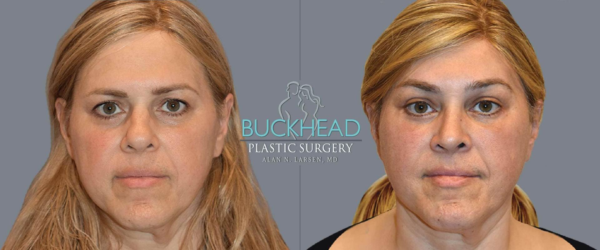 Buckhead Plastic Surgery (Alan N. Larsen MD) brow lift result — Atlanta, GA