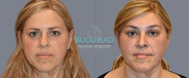 Brow Lift result at Buckhead Plastic Surgery (Alan N. Larsen MD) in Atlanta, GA