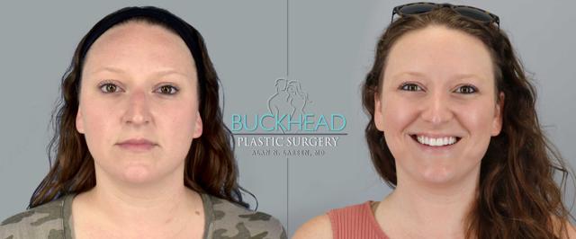 Ethnic Rhinoplasty result at Buckhead Plastic Surgery (Alan N. Larsen MD) in Atlanta, GA