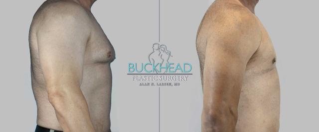 Gynecomastia Surgery result at Buckhead Plastic Surgery (Alan N. Larsen MD) in Atlanta, GA
