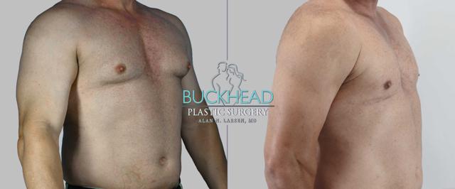 Gynecomastia Surgery result at Buckhead Plastic Surgery (Alan N. Larsen MD) in Atlanta, GA